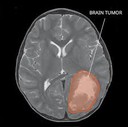 O que é um tumor cerebral?